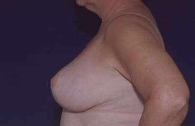 After Image: Breast Reduction - left-side