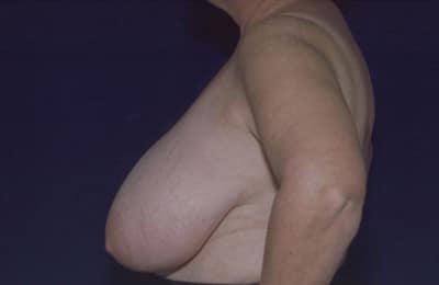 Before Image: Breast Reduction - left-side