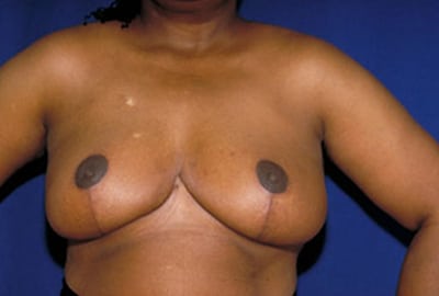 After Image: Breast Reduction - front