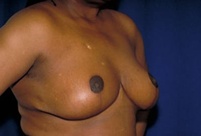 After Image: Breast Reduction - right-front-oblique