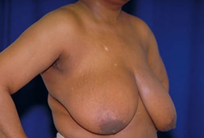Before Image: Breast Reduction - right-front-oblique
