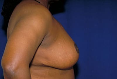 After Image: Breast Reduction - right-side