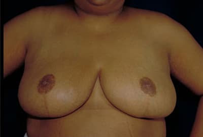 After Image: Breast Reduction - front