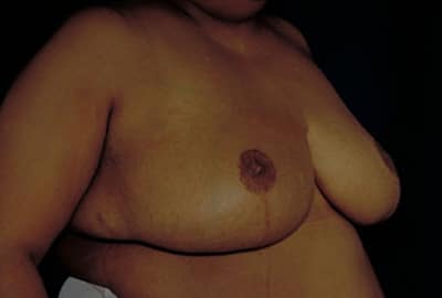 After Image: Breast Reduction - right-front-oblique