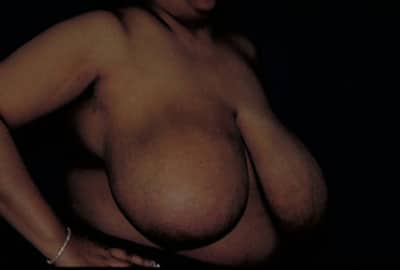 Before Image: Breast Reduction - right-front-oblique