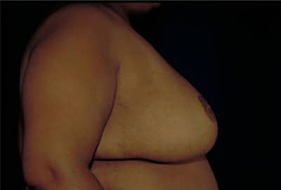 After Image: Breast Reduction - right-side