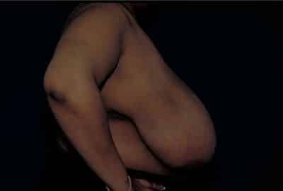 Before Image: Breast Reduction - right-side