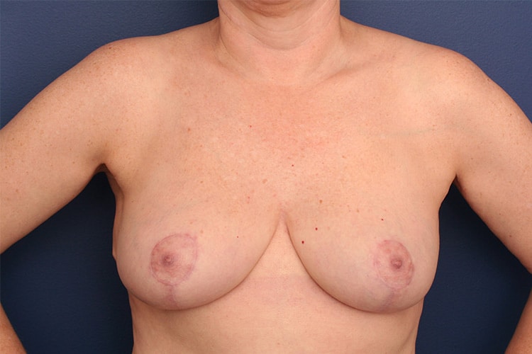 After Image: Breast Reduction - front