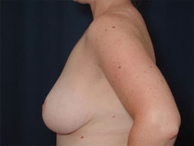 After Image: Breast Reduction - left-side