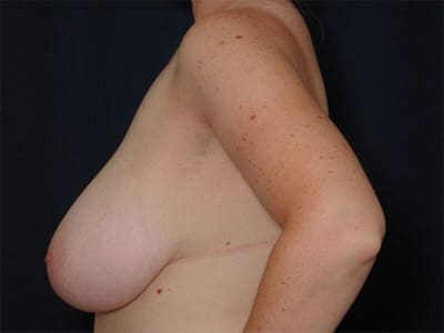 Before Image: Breast Reduction - left-side