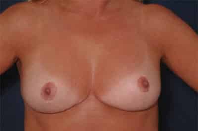 After Image: Breast Reduction - front