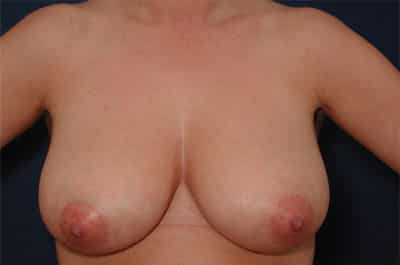 Before Image: Breast Reduction - front