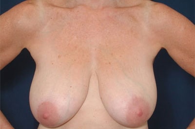 Before Image: Breast Reduction - front