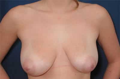 Before Image: Breast Reduction - front