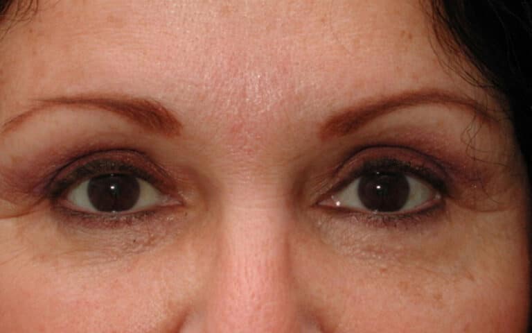 After Image: Brow Lift - front