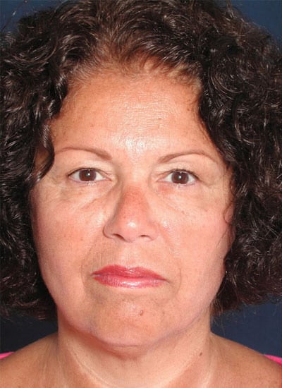 Before Image: Brow Lift - front