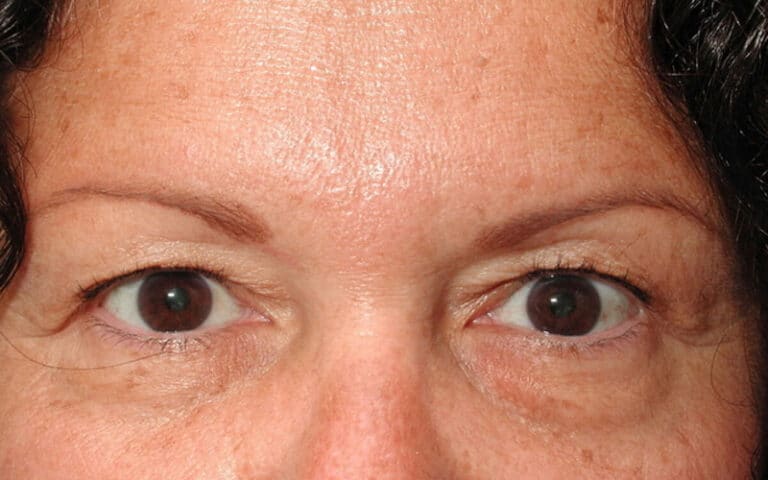 Before Image: Brow Lift - front