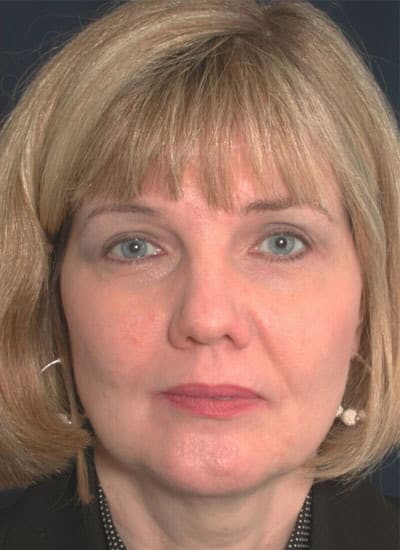 After Image: Brow Lift - front