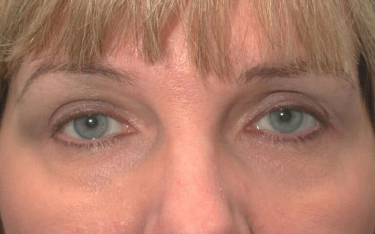 After Image: Brow Lift - front