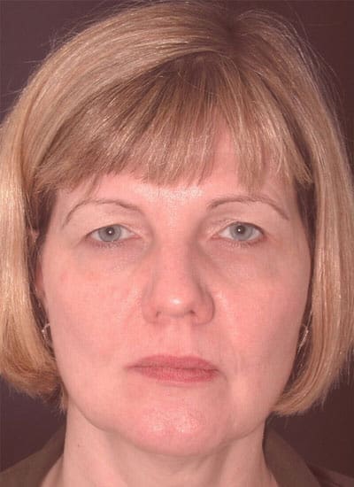 Before Image: Brow Lift - front