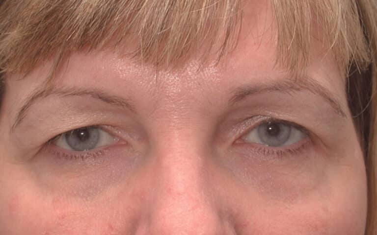 Before Image: Brow Lift - front