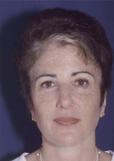After Image: Brow Lift - front