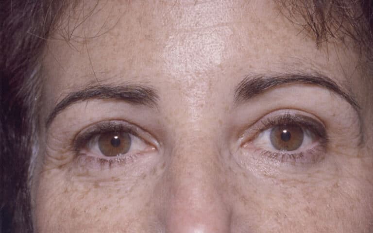 After Image: Brow Lift - front
