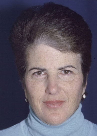 Before Image: Brow Lift - front