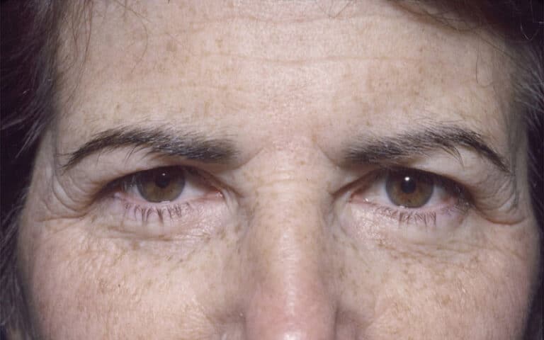 Before Image: Brow Lift - front