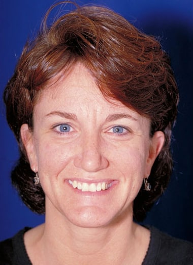 Before Image: Brow Lift - front