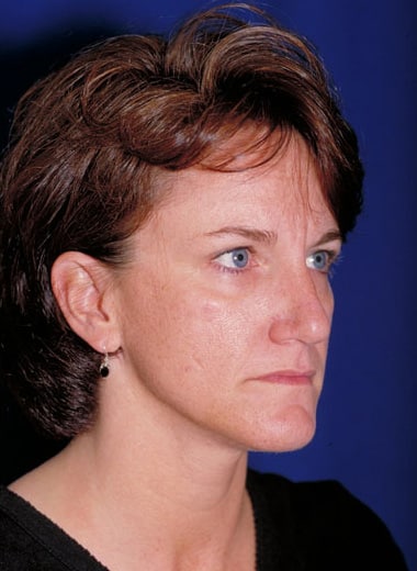 Before Image: Brow Lift - right-front-oblique