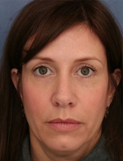 After Image: Brow Lift - front