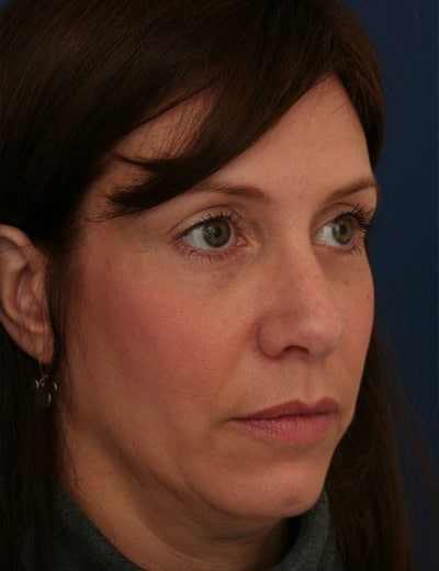 After Image: Brow Lift - right-front-oblique