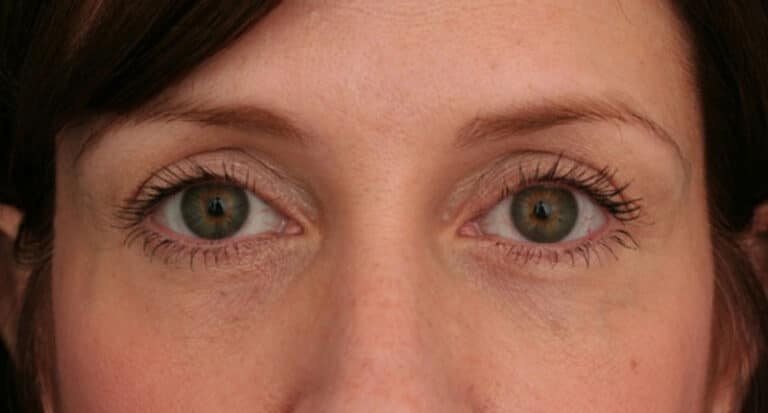 After Image: Brow Lift - front