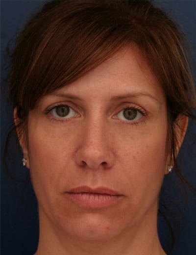 Before Image: Brow Lift - front