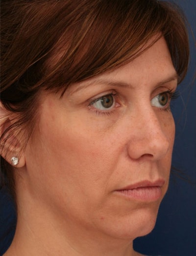 Before Image: Brow Lift - right-front-oblique