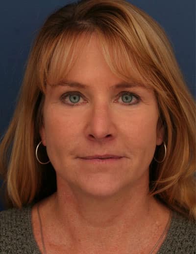 After Image: Brow Lift -