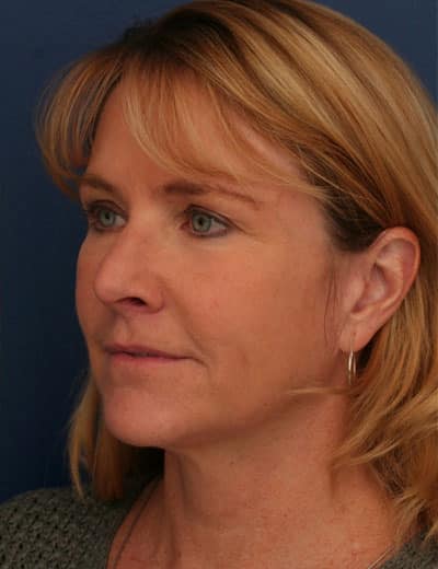 After Image: Brow Lift -