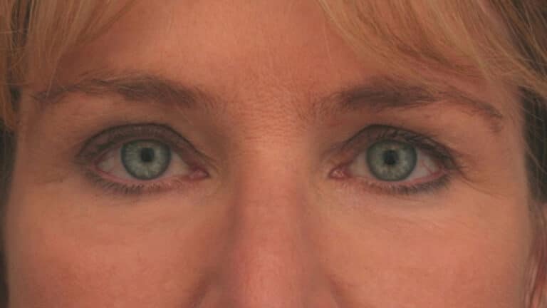 After Image: Brow Lift - front