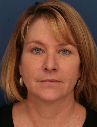 Before Image: Brow Lift -