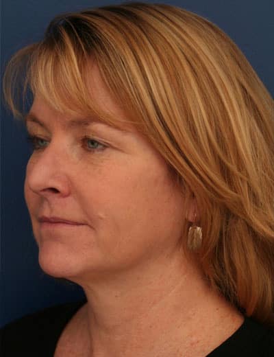 Before Image: Brow Lift -