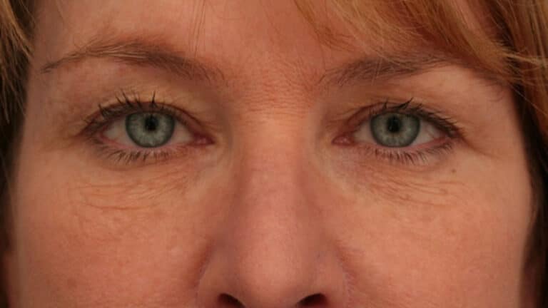 Before Image: Brow Lift - front