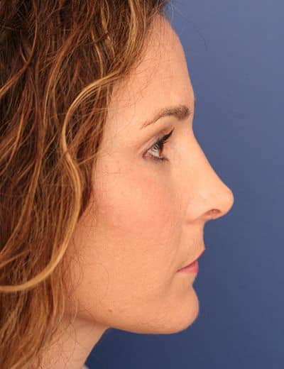 After Image: Brow Lift - right-side