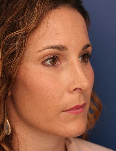 After Image: Brow Lift - right-front-oblique