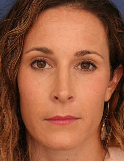 After Image: Brow Lift - front