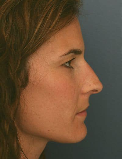 Before Image: Brow Lift - right-side
