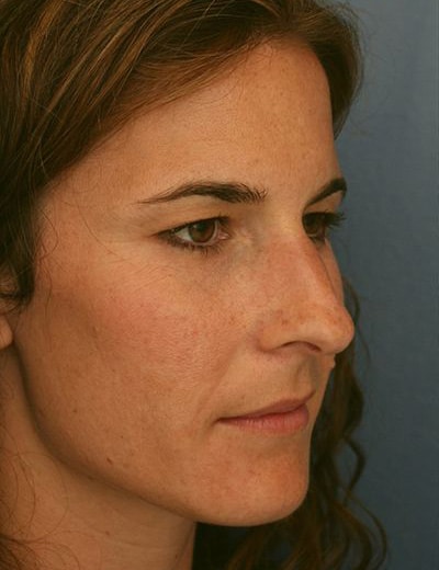 Before Image: Brow Lift - right-front-oblique