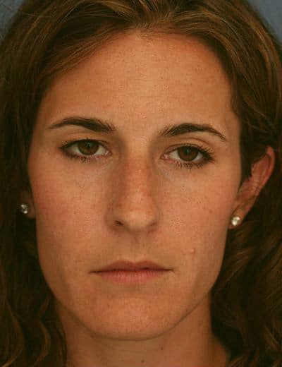 Before Image: Brow Lift - front