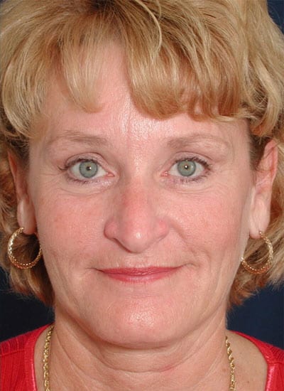 After Image: Brow Lift - front