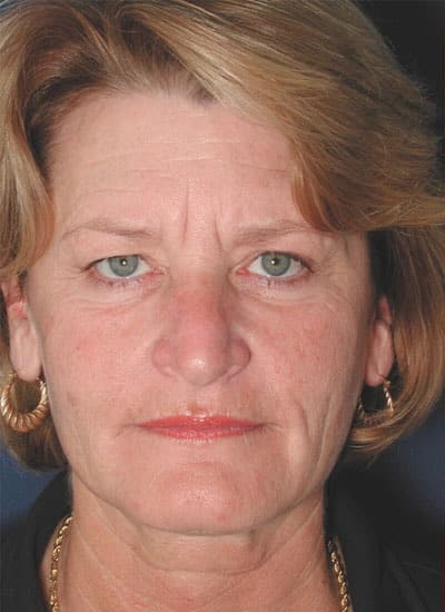 Before Image: Brow Lift - front